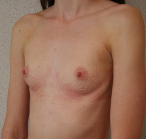 Breast Augmentation