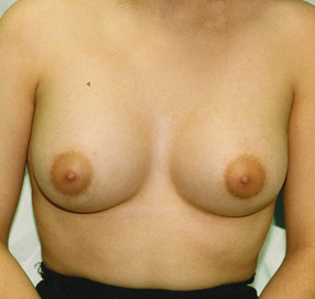 Breast Augmentation