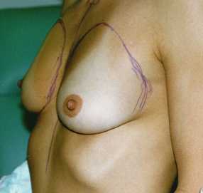 Breast Augmentation