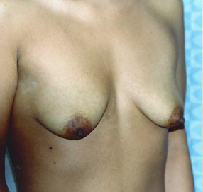 Breast Augmentation