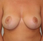 Breast Reduction