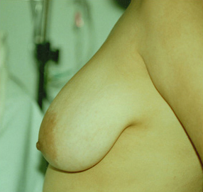 Breast Reduction