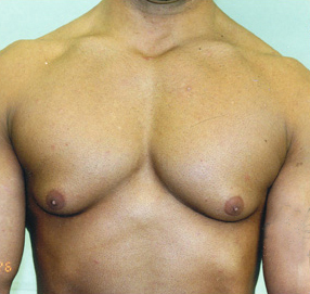 Gynecomastia