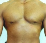 Gynecomastia