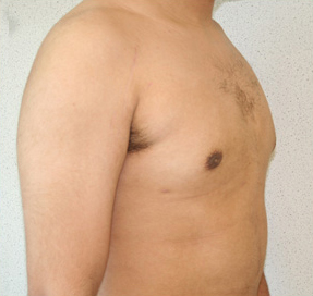 Gynecomastia