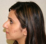 Rhinoplasty