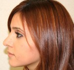 Rhinoplasty