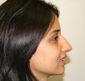 Rhinoplasty