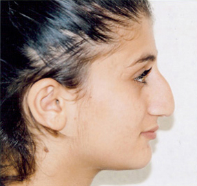 Rhinoplasty