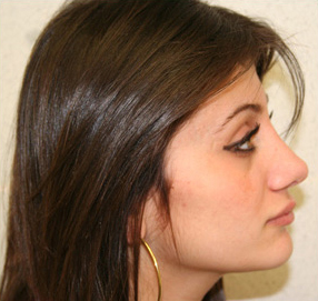 Rhinoplasty