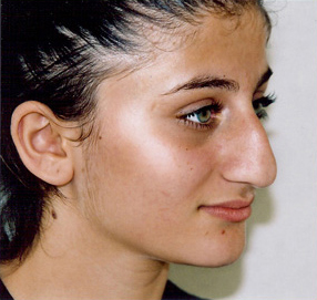 Rhinoplasty