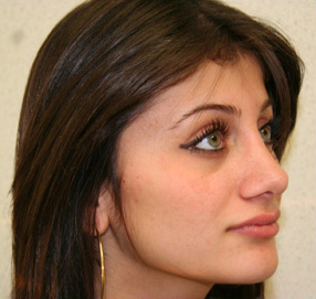 Rhinoplasty