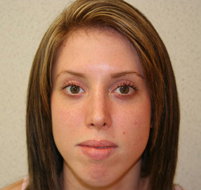 Rhinoplasty