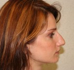 Rhinoplasty