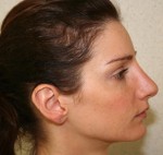 Rhinoplasty