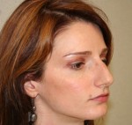 Rhinoplasty