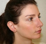 Rhinoplasty