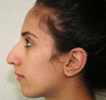 Rhinoplasty