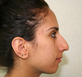 Rhinoplasty