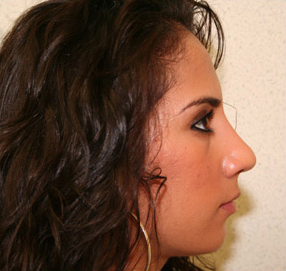 Rhinoplasty