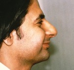 Rhinoplasty