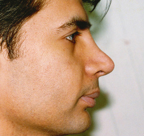 Rhinoplasty
