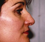 Rhinoplasty