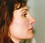 Rhinoplasty