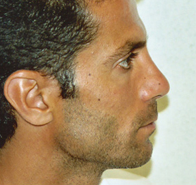 Rhinoplasty