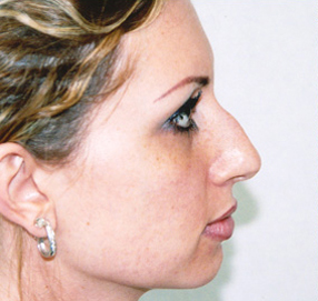 Rhinoplasty