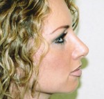 Rhinoplasty