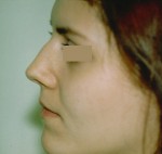 Rhinoplasty