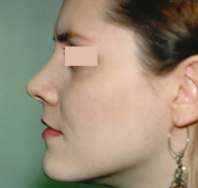 Rhinoplasty