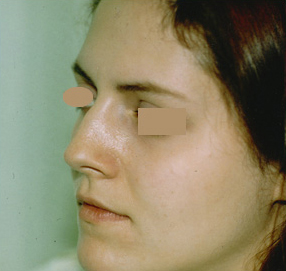 Rhinoplasty