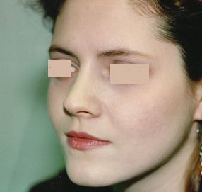 Rhinoplasty