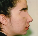 Rhinoplasty