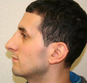 Rhinoplasty