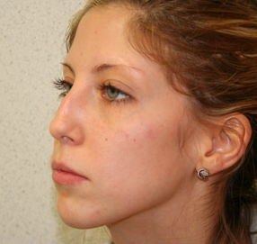 Rhinoplasty