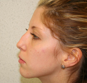 Rhinoplasty