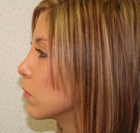 Rhinoplasty