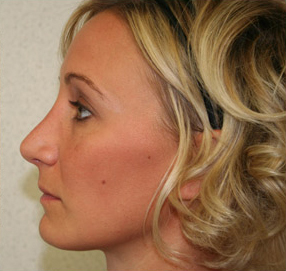 Rhinoplasty