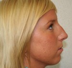 Rhinoplasty