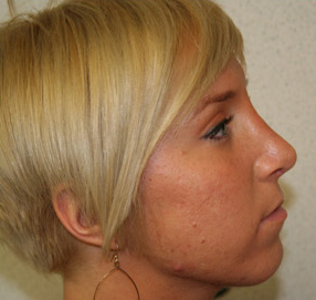 Rhinoplasty