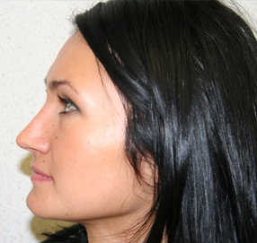 Rhinoplasty