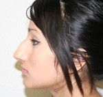 Rhinoplasty