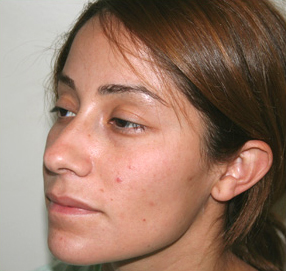 Rhinoplasty