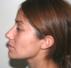 Rhinoplasty