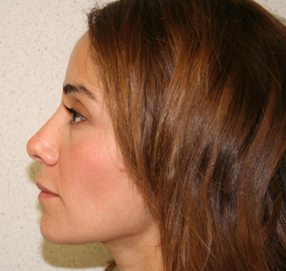 Rhinoplasty