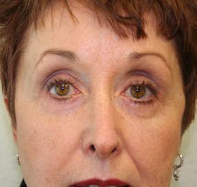 Blepharoplasty