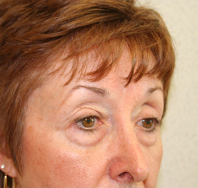 Blepharoplasty